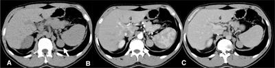 Case Report: Adrenocortical Oncocytoma in a Patient with a Previous Contralateral Adrenalectomy for a Cortisol-Secreting Adenoma